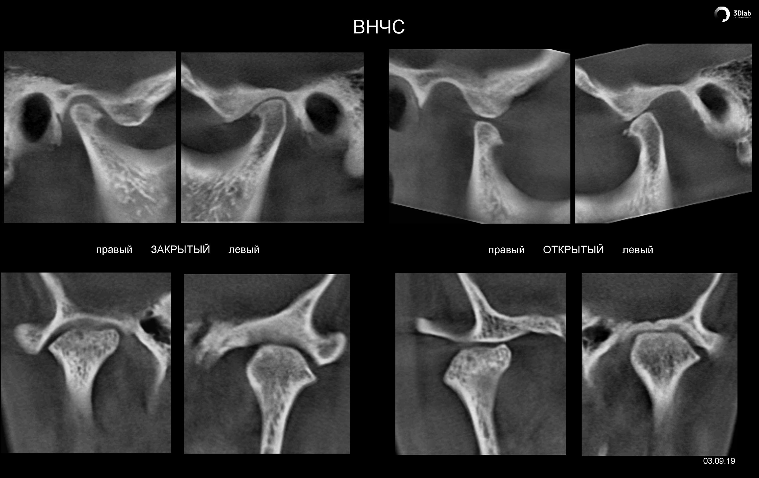 Мрт внчс. Артроз височно-нижнечелюстного сустава кт. Конусно-лучевая компьютерная томография ВНЧС. Артроз нижнечелюстного сустава кт.