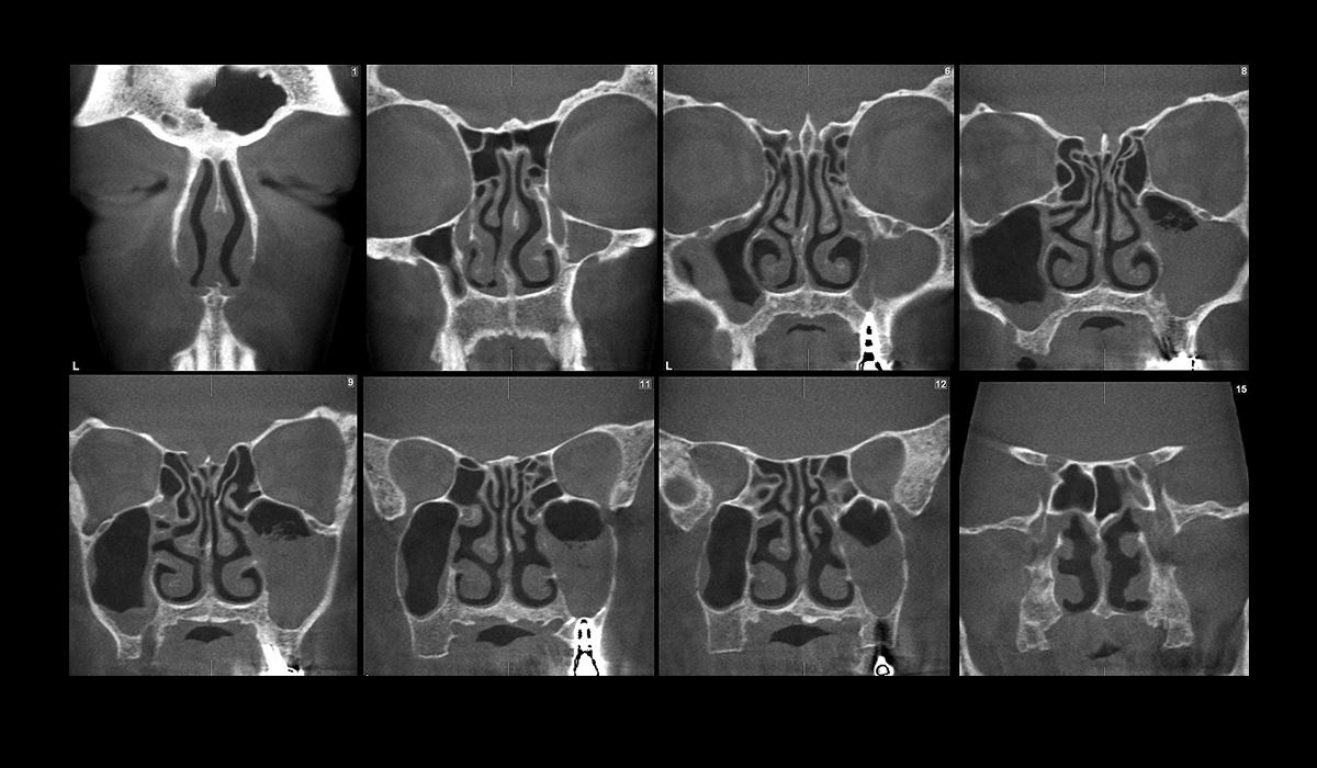 Кт пазух носа фото